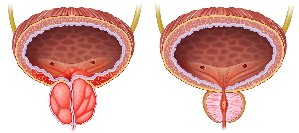 Entzündete und gesunde Prostata nach der Verwendung von Prestonorm -Kapseln