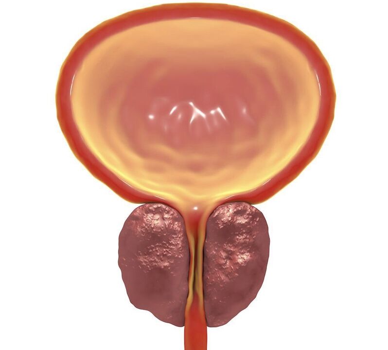 Entzündung einer chronischen Prostatitis