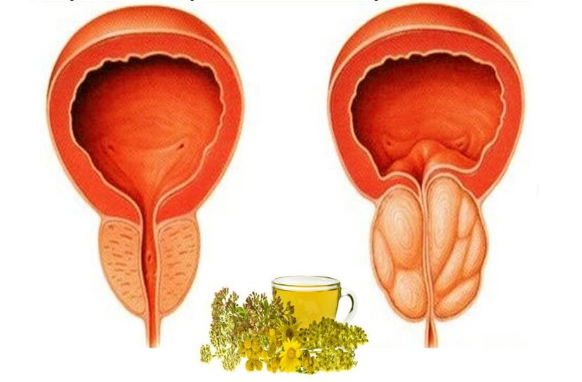 Gesunde und schmerzende Prostata